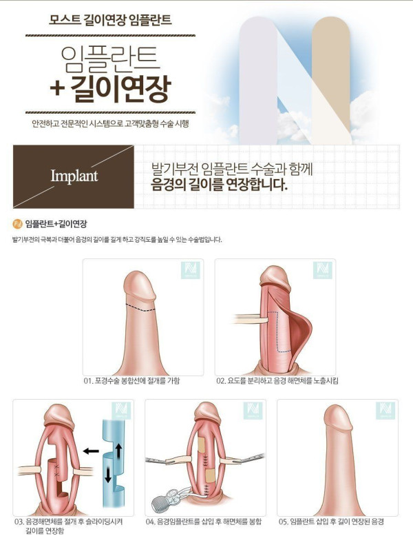 7000번 수술한 비뇨기과 의사도 불가능하다는 영역